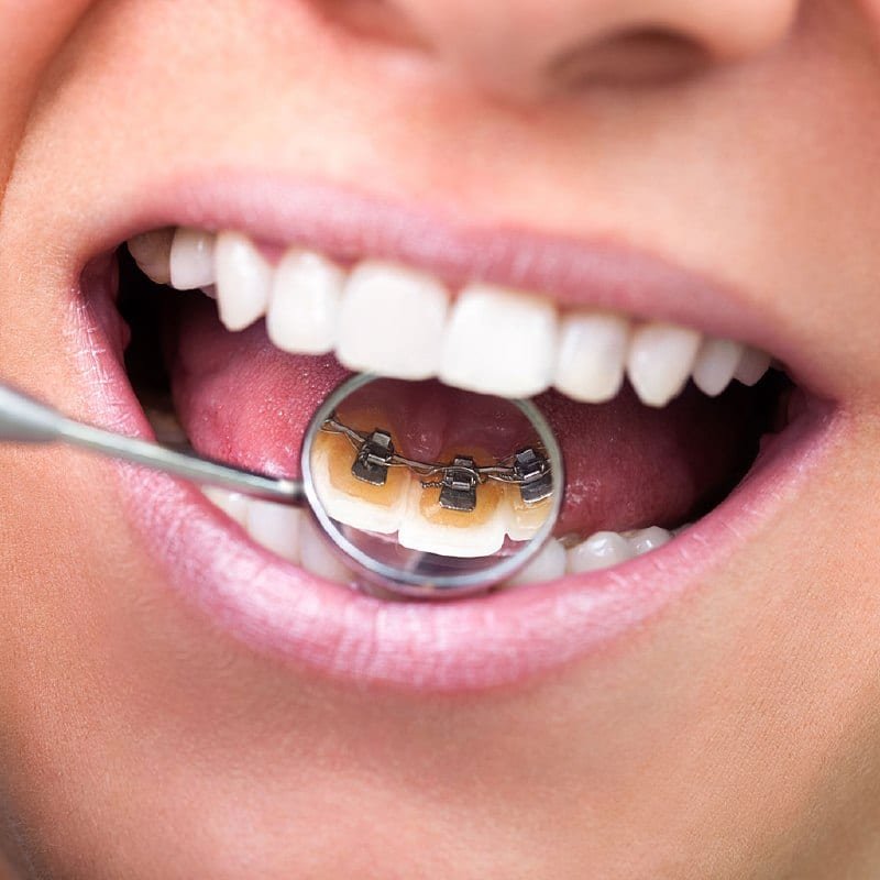 Invisible Braces