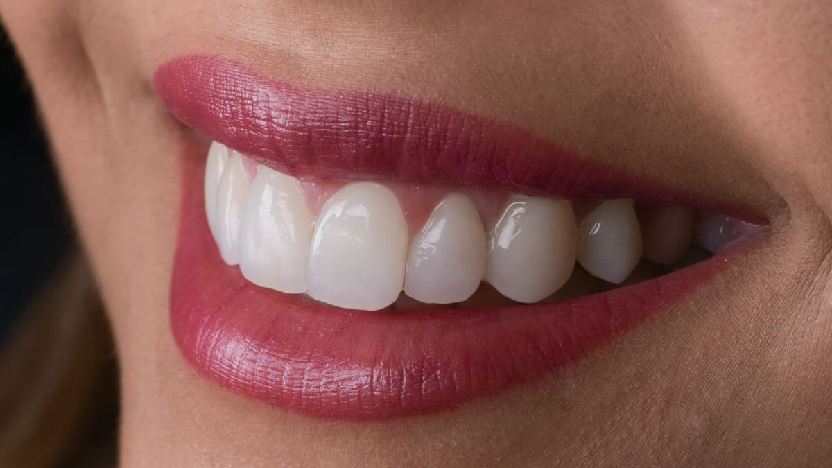 Porcelain Veneers
