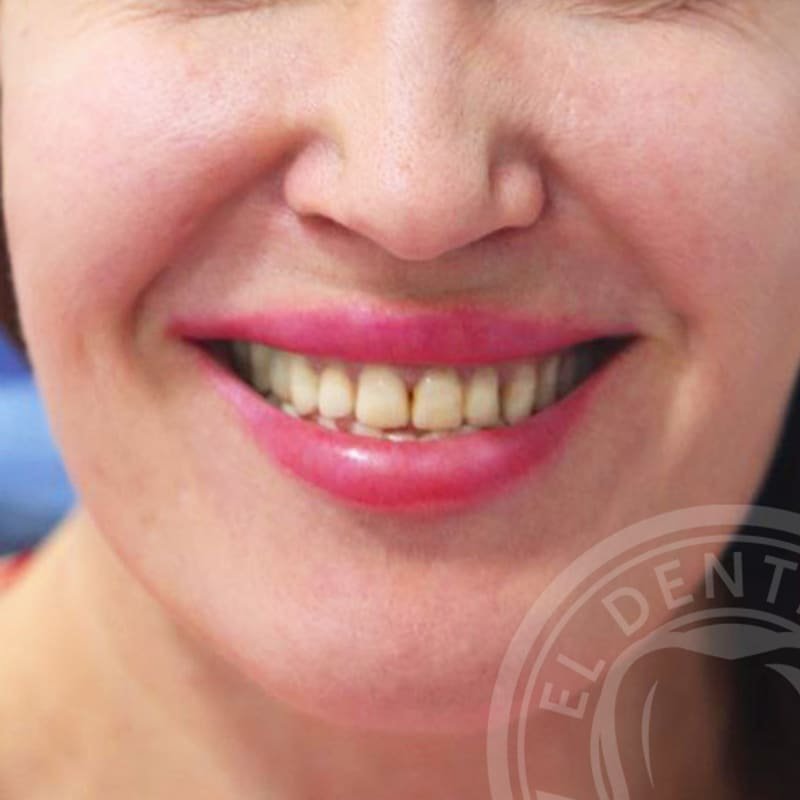Before: Smile Transformation · Case 01