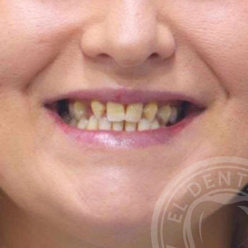 Before: Smile Transformation · Case 02