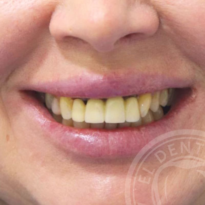Before: Smile Transformation · Case 03