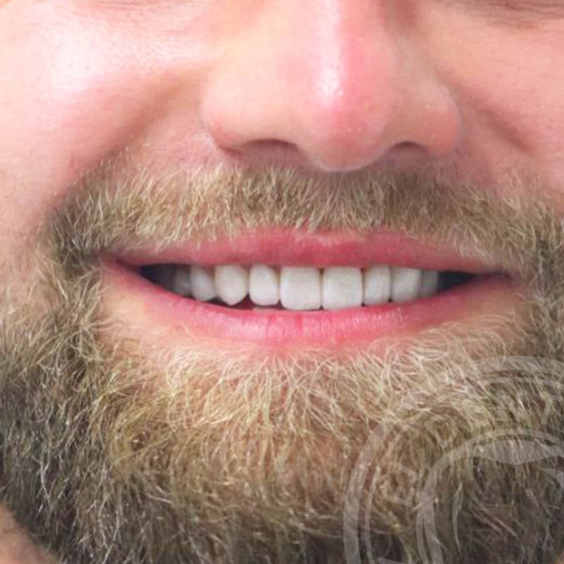 After: Smile Transformation · Case 04