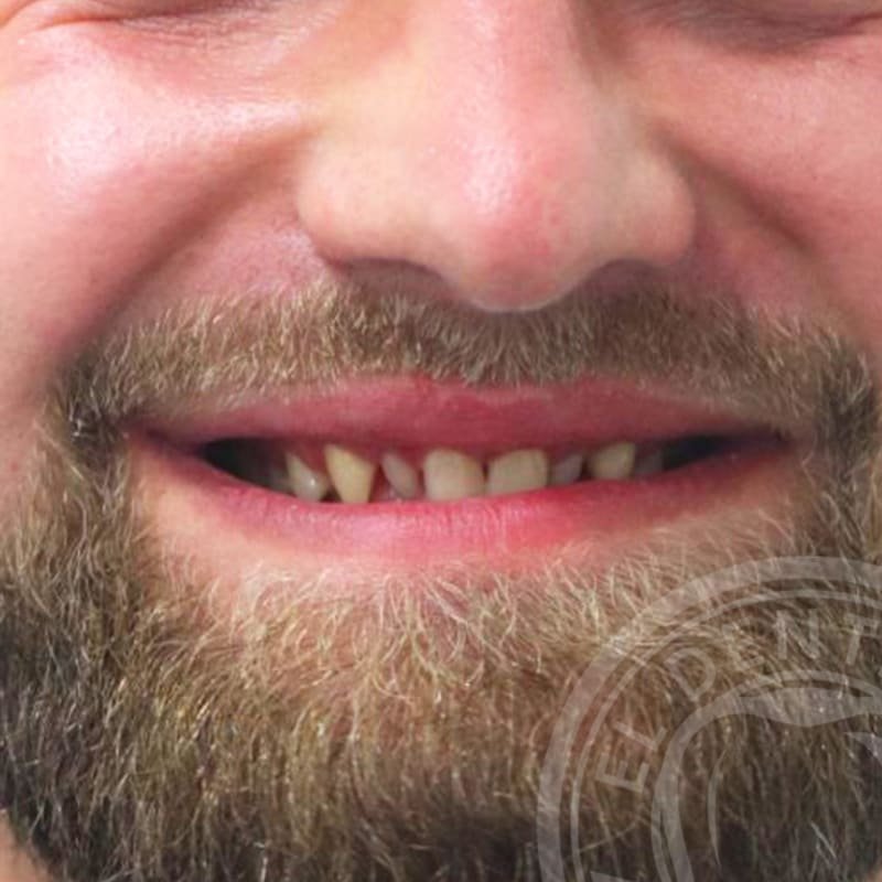 Before: Smile Transformation · Case 04