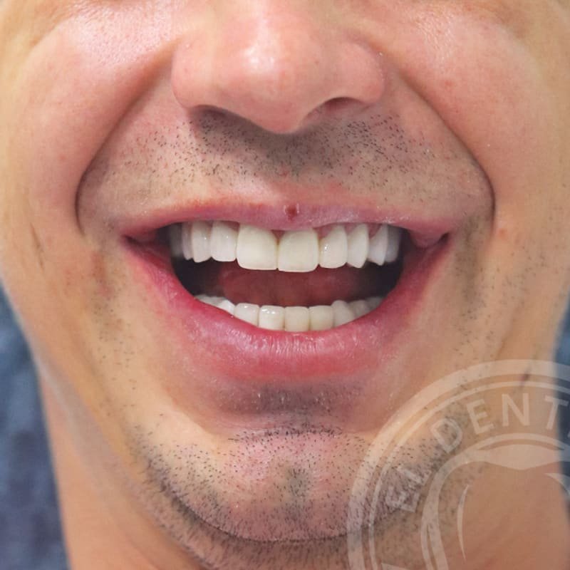 After: Smile Transformation · Case 05