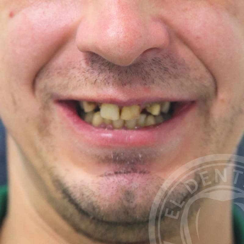 Before: Smile Transformation · Case 05