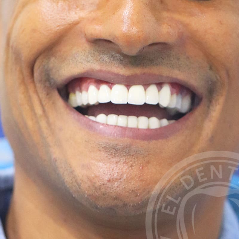 After: Smile Transformation · Case 06