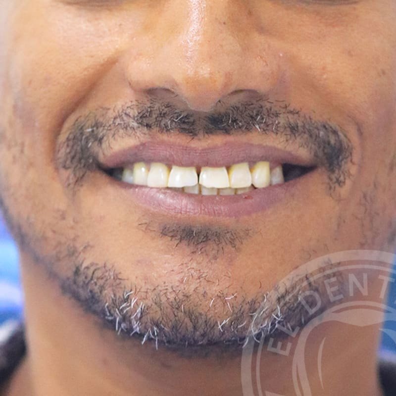 Before: Smile Transformation · Case 06
