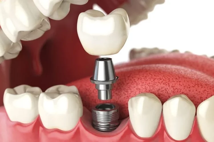 "How bone is implanted in dental implants with titanium"