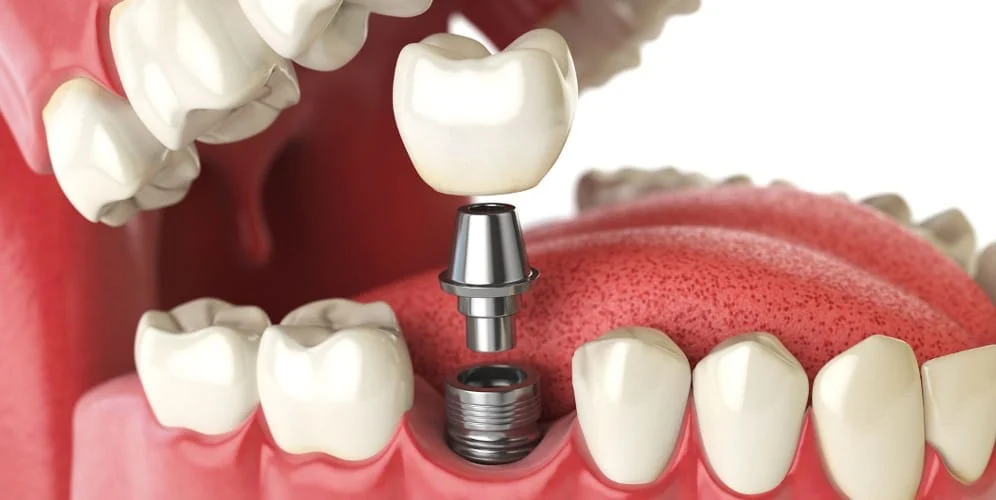 "How bone is implanted in dental implants with titanium"