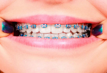 "Лечение щелей между зубами"