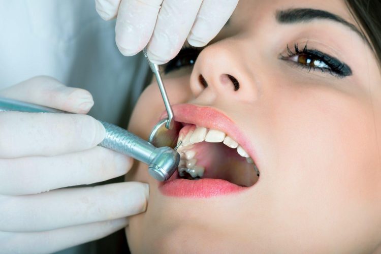 Что такое пломбирование зубов?"