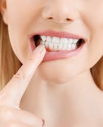 "Каковы симптомы гингивита? Как это можно лечить?"