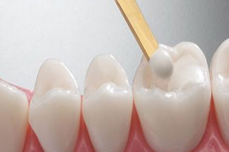 "The best types of dental fillings"