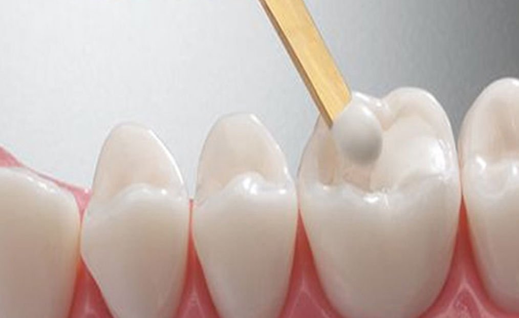 "The best types of dental fillings"